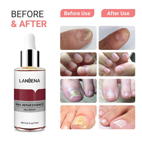 LANBENA Nail Repair Essence,